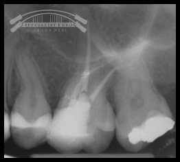Postobturation radiograph.