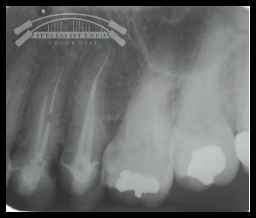 Fractured file in 24 and 25.