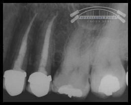 Postobturation with composite cores and PFM crowns.