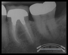 Postobturation with crowns fitted.